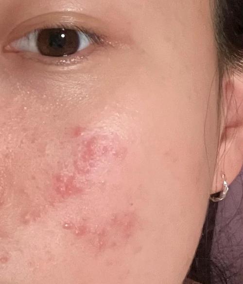 香蕉皮敷脸的过敏风险与替代