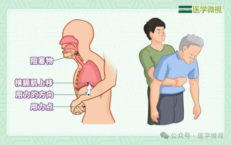 食物噎住窒息？海姆立克急救法详细图解