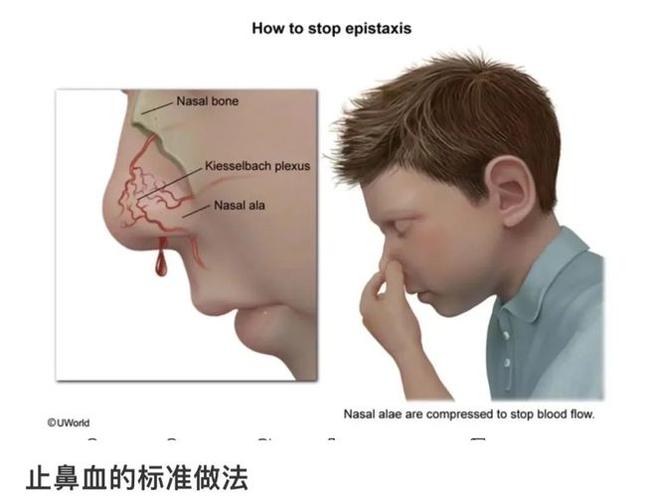 流鼻血时仰头是大忌！正确止血姿势要记牢