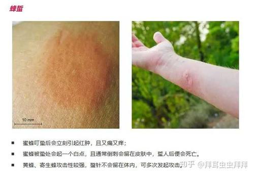 蜂蜇过敏反应分级:这些症状需立即就医