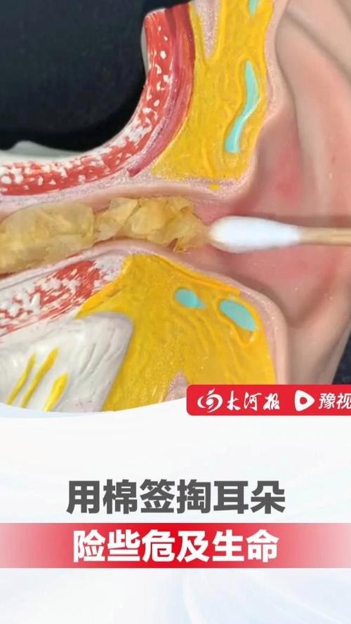 棉签掏耳朵可能推耳垢更深？