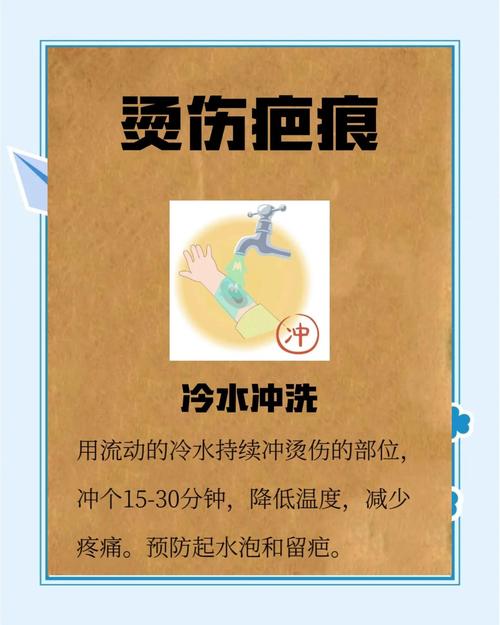 牙膏能治烫伤？烧伤科医生紧急处理指南
