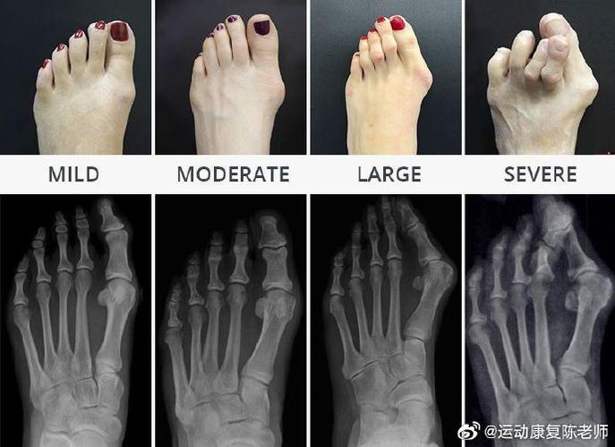 鞋子穿久了变形怎么办？