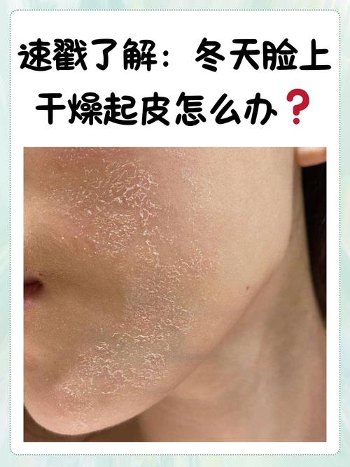 为什么冬天皮肤容易干燥脱皮？