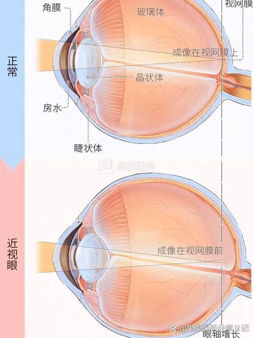 为什么人会近视？