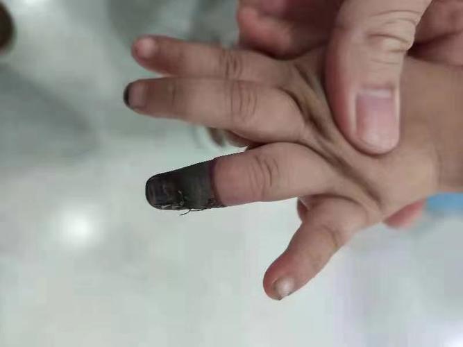 创可贴包扎过紧会截肢?