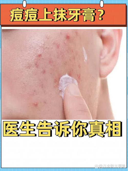 牙膏能治痘痘？皮肤科医生解析抗菌成分
