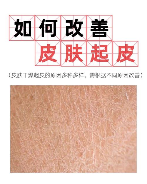 为什么冬天皮肤容易干燥起皮?
