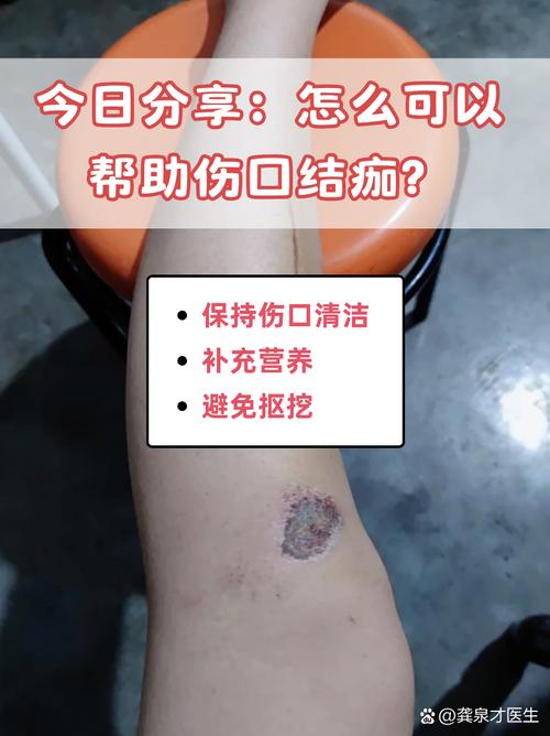 伤口结痂瘙痒怎么办?涂抹凡士林防抓挠