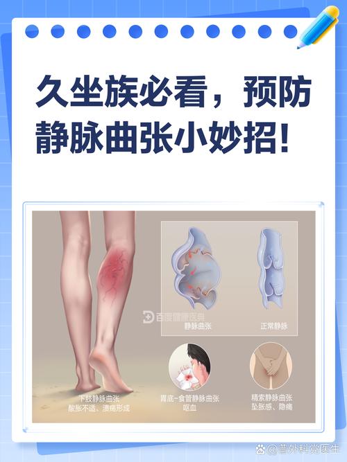 如何预防静脉曲张?久坐久站人群必看