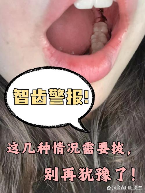 智齿是否需要拔除