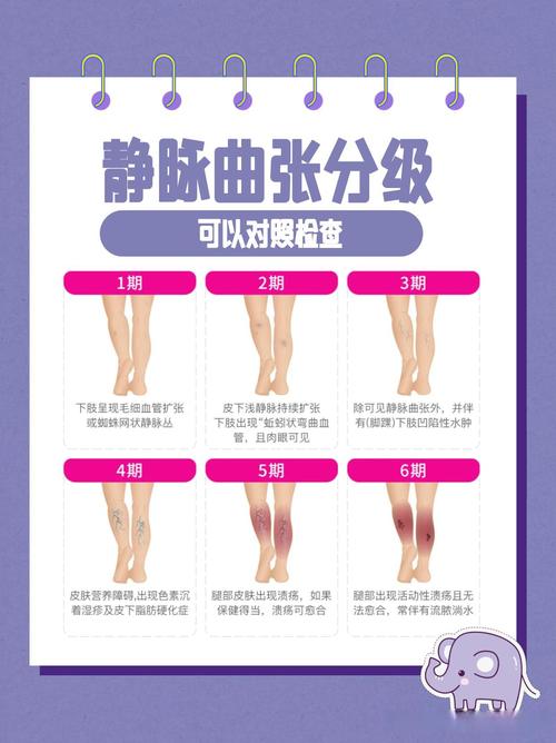 久站人群静脉曲张预防