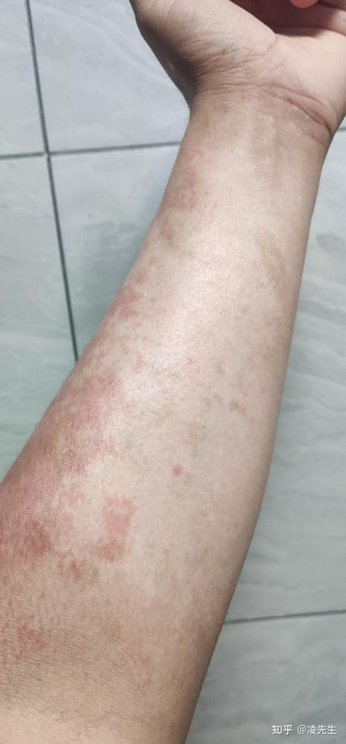 烫伤后皮肤颜色变化?Ⅰ° 与 Ⅱ° 区分