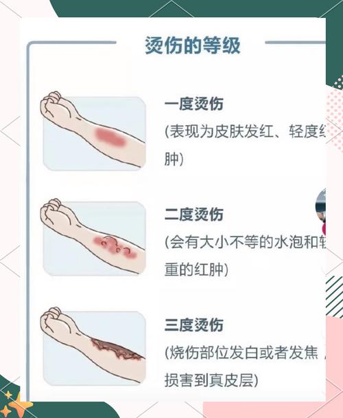 烫伤感染征兆识别?红肿热痛加剧