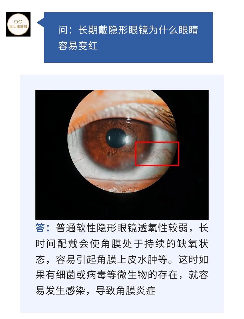 隐形眼镜佩戴超时危害?角膜缺氧程度