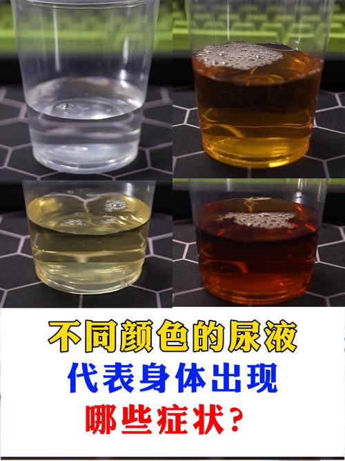 蜂蛰后肾功能监测?尿液颜色观察
